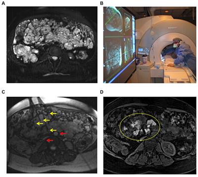 Magnetic resonance – guided treatment of low-flow vascular malformations and the technologies to potentiate adoption